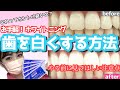 【歯を白くする方法】簡単ホワイトニング!一歩間違えると歯を失う?!注意事項必見!!!