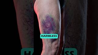 Easy Bruising? Your Body Might Be Warning You #health #DrMD360 #shorts