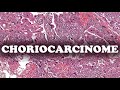 Le choriocarcinome  pathologie