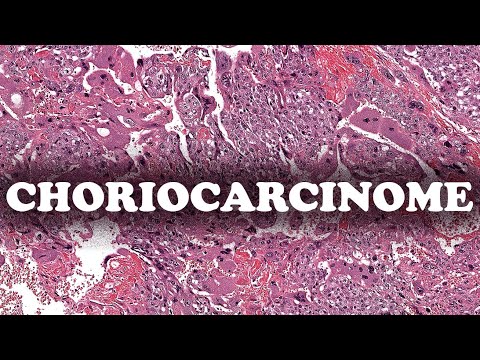 Vidéo: Le choriocarcinome est-il un type de cancer ?