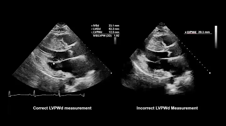 How to Measure Wall Thickness with Echocardiography