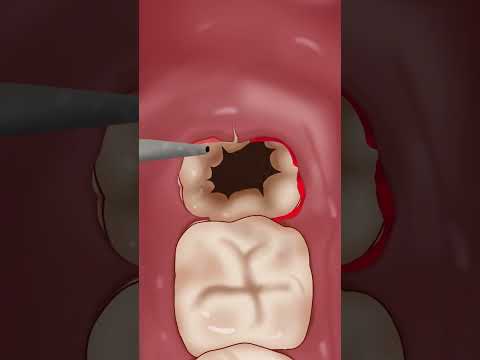 ASMR Wisdom teeth removal treatment P2 #asmr #animation #satisfying #viral #trending #shorts