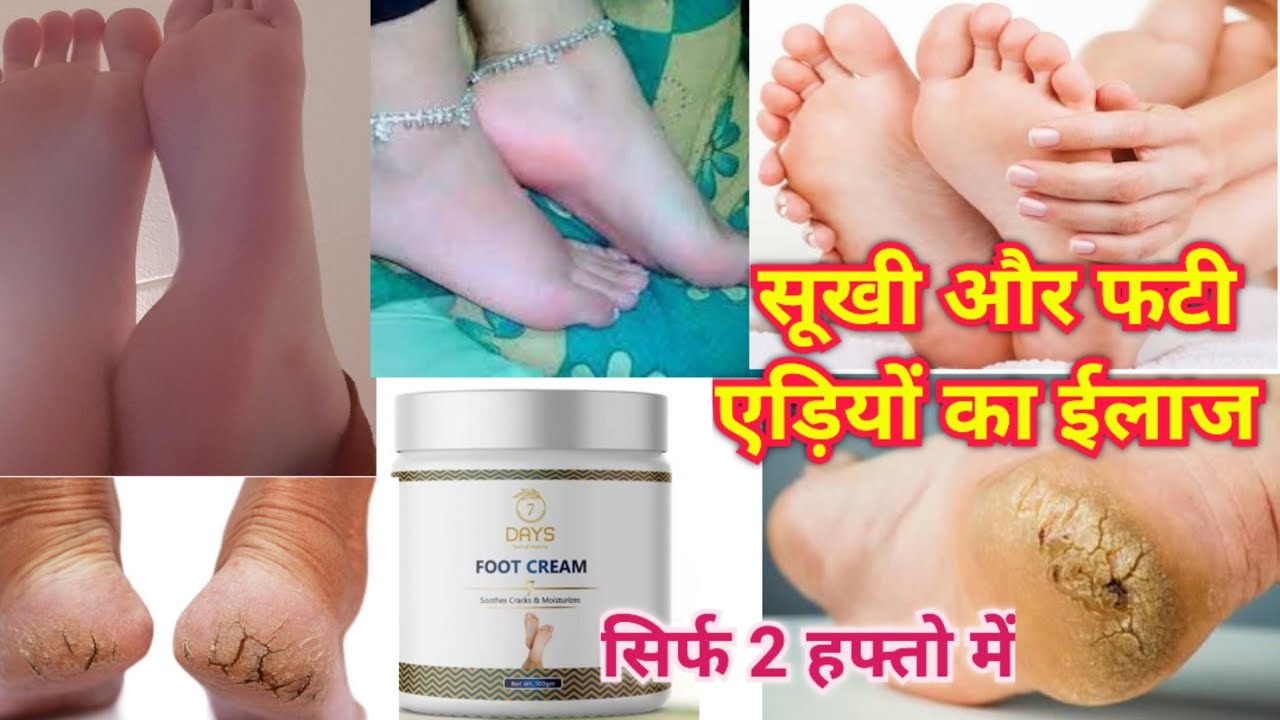 सूखी और फटी एड़ियों का ईलाज | 7Days Organic Foot Cream Review | Treatment of Dry and Cracked Heels