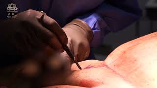 Enlargement Surgery! 🔥Dr Anaya shows us the shocking procedure- Vive Plastic Surgery