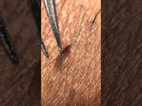 Ingrown hair plucking / tweezing ASMR Bikini Line