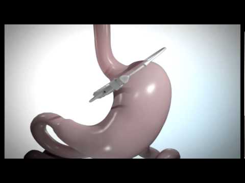 Bariatric Weight Loss - Laparoscopic Adjustable Gastric Band