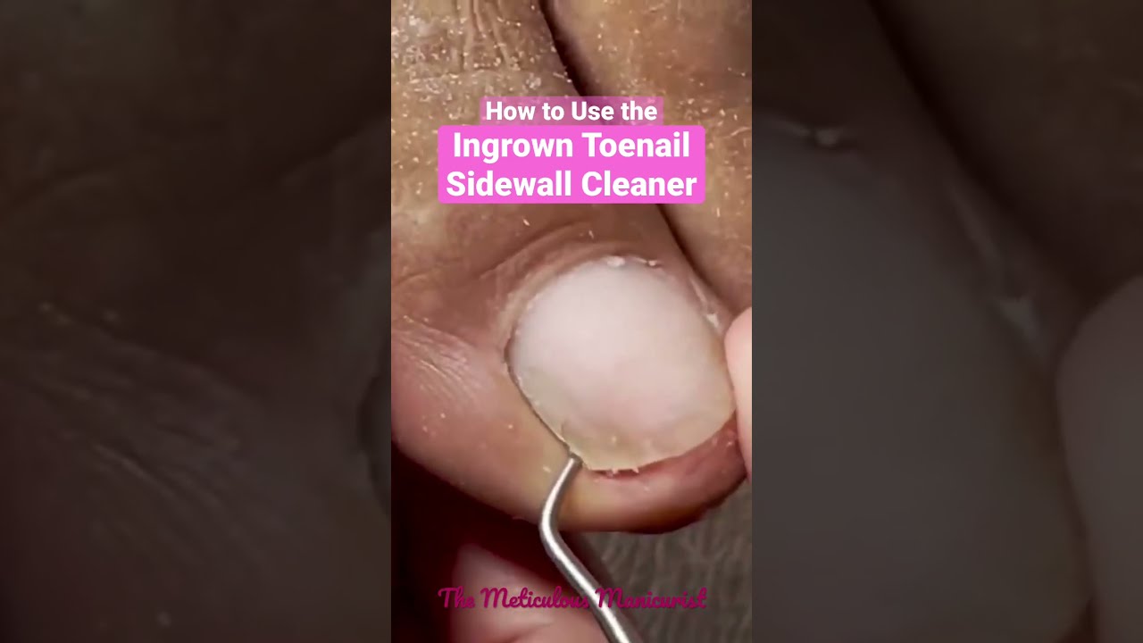 How To Use The Ingrown Toenail Sidewall Cleaner Ingrowntoenail Pedicure Meticulousmanicurist