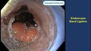 Esophageal varices: Endoscopy Band Ligation (EBL)