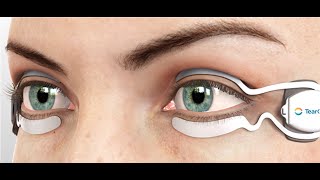TearCare Technology at Eyepic Eye Care