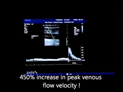 Doppler video showing the peak flow velocity generated by the homefit