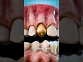 Why dentists still use gold teeth 