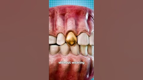 Why Dentists Still Use Gold Teeth 🤔