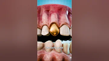 Why Dentists Still Use Gold Teeth 🤔