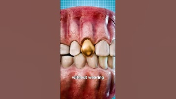 Thumbnail of Why Dentists Still Use Gold Teeth 🤔