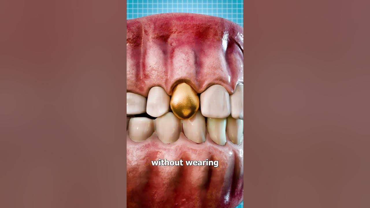Why Dentists Still Use Gold Teeth 🤔