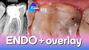 ENDO + overlay | BG Dental Cases #24