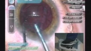 Cataract Surgery Los Angeles Surgeon Uday Devgan Md Showing Best Techniques Aao