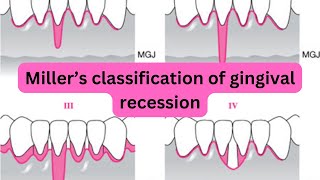 What is Miller's Classification of Gingival Recession