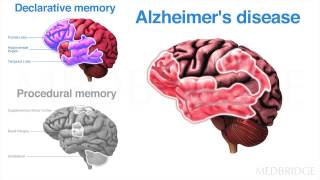 Dementia & Capacity for Learning in Rehabilitation Sciences Video : Carrie Ciro | MedBridge
