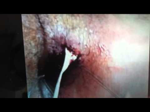 Proctologista   Cirurgia de Drenagem de Abscesso Anal