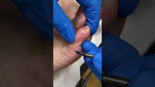 Brave The Process! Watch As An Aussie Podiatrist Tackles Tough Callus Removal!