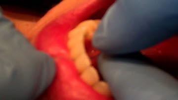 How to Floss a Lower Bonded Retainer