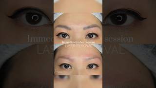 Q switch laser removal to the rescue ‼️🦸🏻‍♀️ #tattooremoval #qswitch Profile