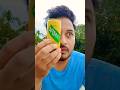 😱Mắt Lồi Cực Độ! Điều Gì Đã Xảy Ra Với Nhãn Cầu?👁️🔥 #Shorts #Exophthalmos#viral