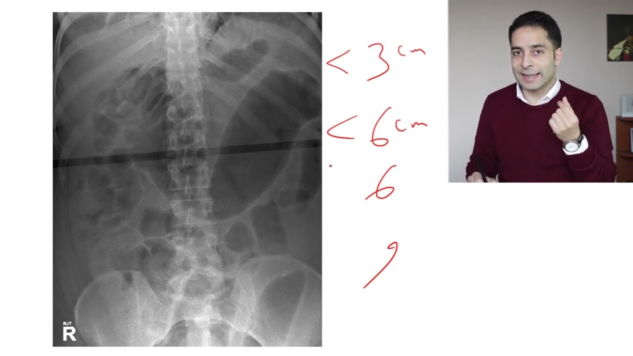 Inflammatory Bowel Disease `4` |  الامتحان الوطني الموحد | Complications of UC