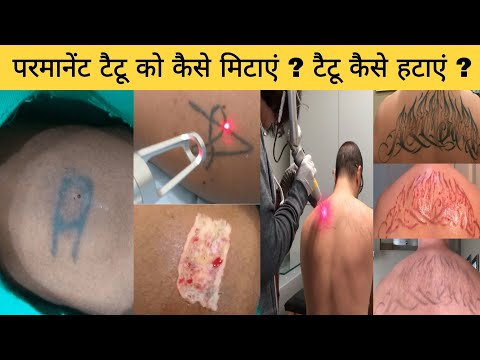 वीडियो: क्या स्टिक एंड पोक टैटू हटाना आसान है?