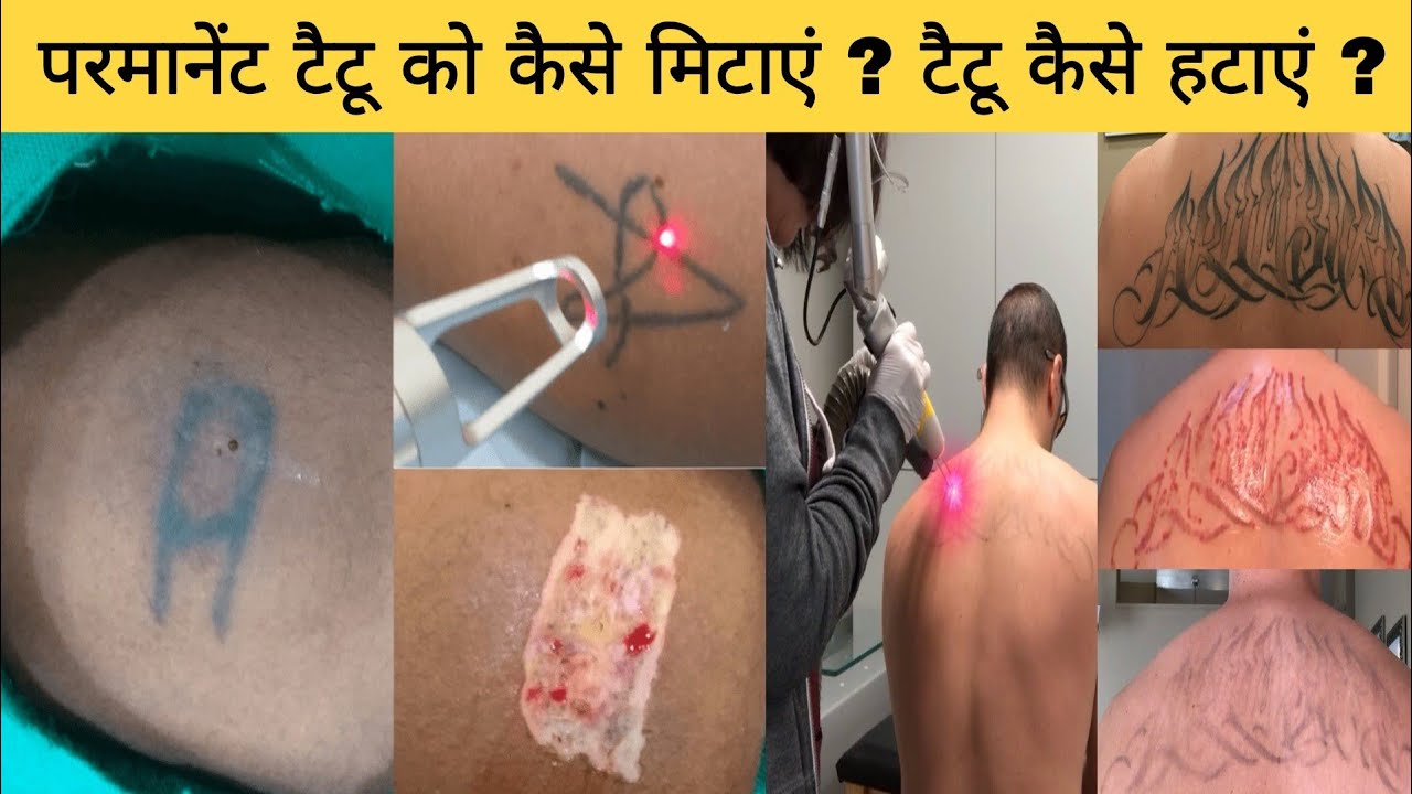 टट कस नकल  How to Remove Permanent Tattoo at Home  Tattoo Kaise  Mitaye  Tattoo Removal  YouTube