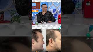 Ximbinha mostra ‘antes e depois’ do procedimento facial feito pelo artista