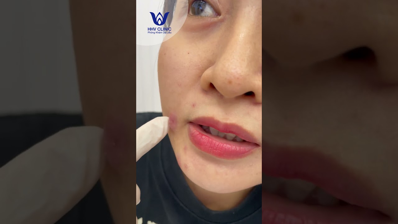 Mụn áp xe cứng ở má.