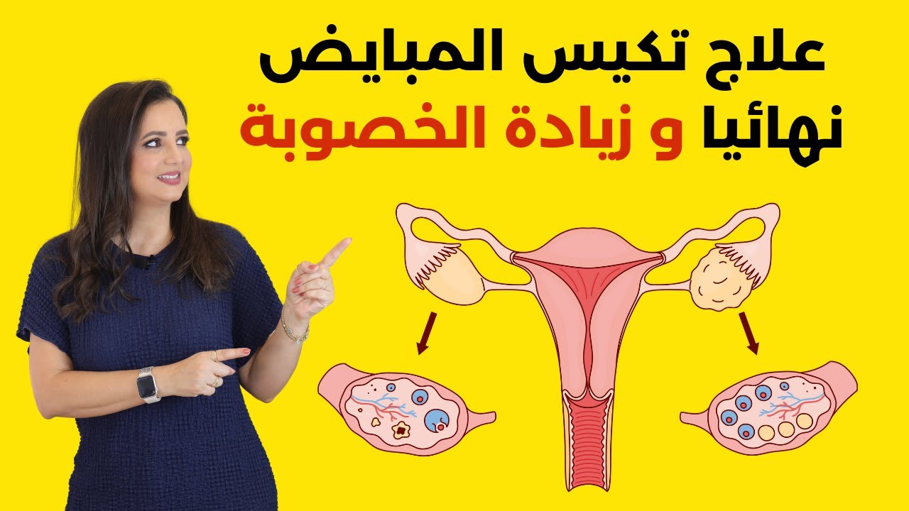 علاج تكيس المبايض نهائيا في خطوات بسيطة د.ربى مشربش