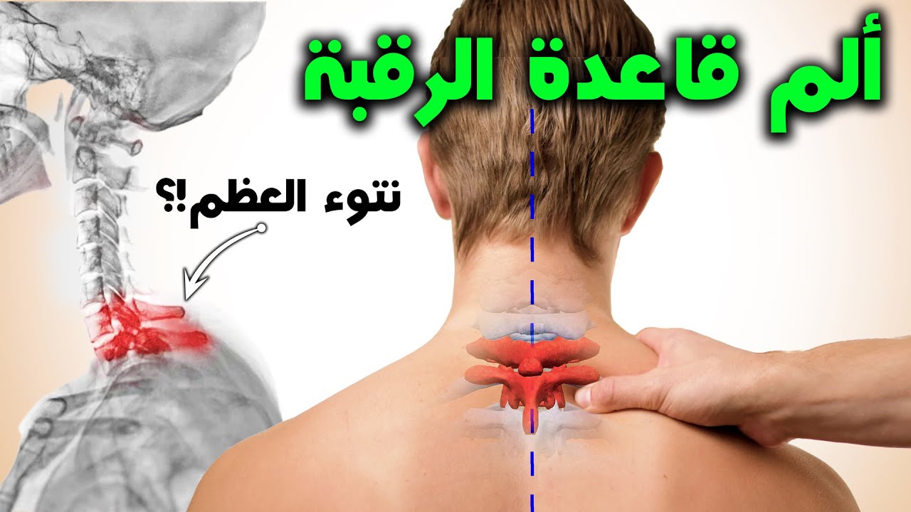 تخلص من ألم قاعده الرقبة || نتوء عظم أسفل الرقبة || Cervicothoracic Joint Dysfunction