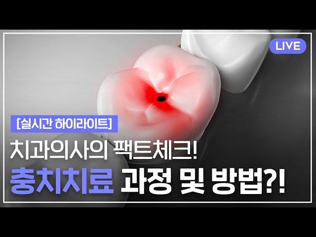 [실시간 하이라이트] 충치 치료의 과정과 치료방법!! 치아 레진, 인레이, 크라운 등 충치치료의 모든것💡