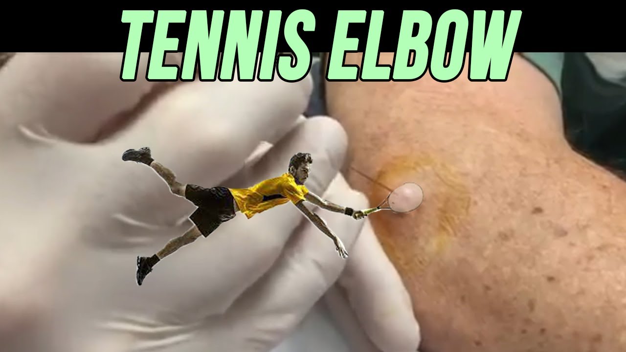 Severe Tennis Elbow and The Tale of The Broken Neck YouTube