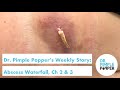 Dr. Pimple Popper's Weekly Story: Abscess Waterfall Ch 2 & 3!