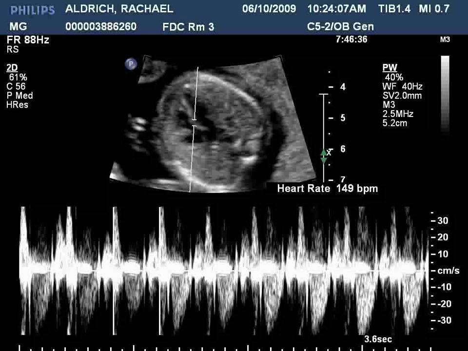 baby heartbeat