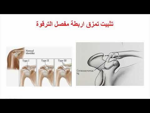 تثبيت خلع مفصل الترقوه بالمنظار