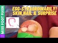 Egg Straordinarily! Not your Usual Ingrown toenail surgery| Miss foot fixer Marion Yau