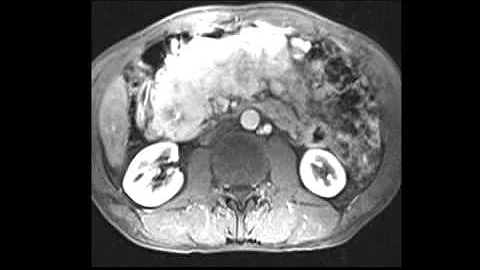 Large pancreatic neuroendocrine tumor