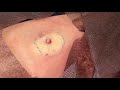 粉瘤くりぬき法 20代女性肩epidermal cyst atheroma cystic acne extractions 脂肪腫 lipoma クリニーク大阪心斎橋 大阪梅田院 名古屋院 福岡院
