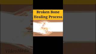 Broken Bone Healing