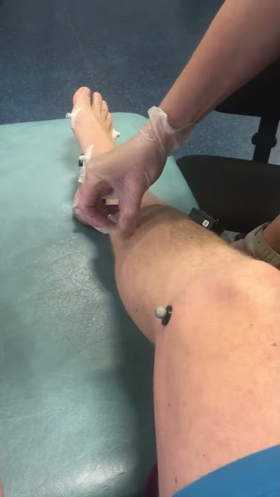 Indwelling EMG into Tibialis Posterior