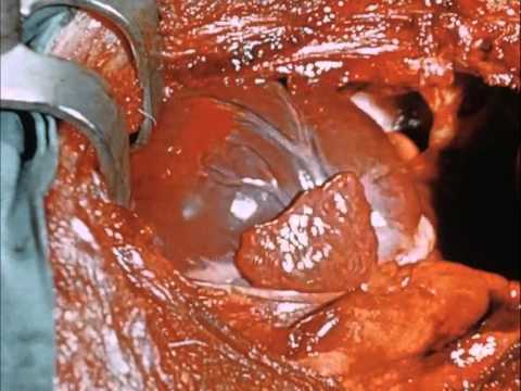 Video: How Was The Operation With Circulatory Arrest Performed?