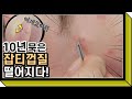 노광고) 10년묵은 잡티가 벗겨지는 신기한 영상!!!! 심장약한 분들 시청금지/ 김기수