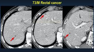 Difficult hepatic lesion on preoperative staging of rectal cancer