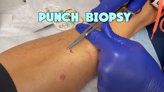 Gigi&#39;s Punch Biopsy - Dermatofibroma Excision