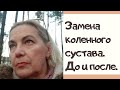 Замена коленного сустава. До и после.